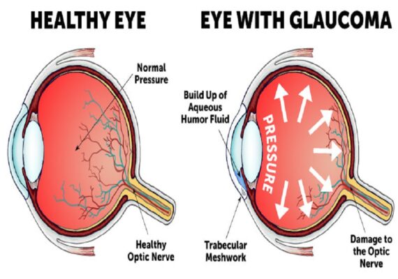 GlaucomaEyeDiagram-min GlaucomaEyeDiagram-min