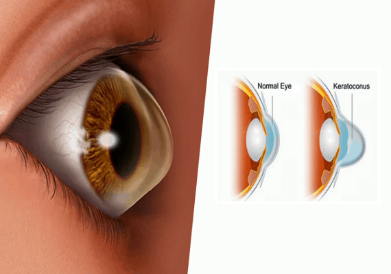 Keratoconus Keratoconus