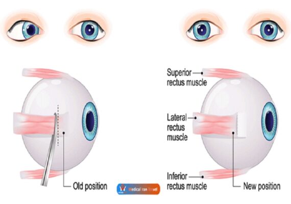 strabismus-surgery-procedure strabismus-surgery-procedure