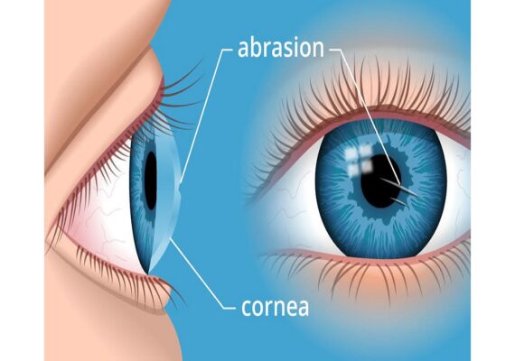 corneal-abrasion-1200x630 corneal-abrasion-1200x630